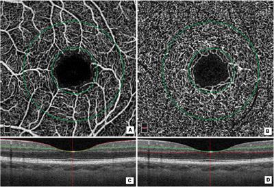 Correlation between retinal vessel rarefaction and psychometric measures in an older Southern Italian population
